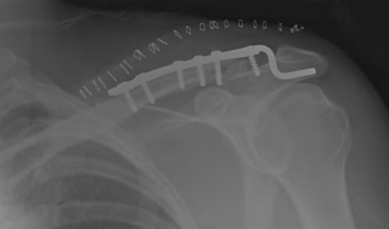 Lateral Clavicle Fracture Hook Plate Post op